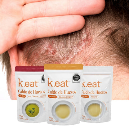 Programa de Caldo de Huesos Psoriasis